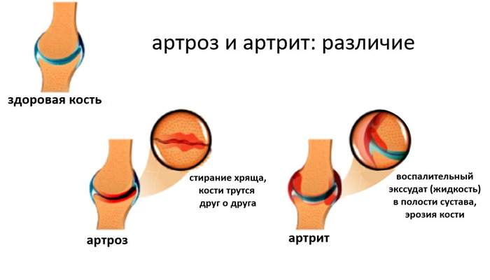различия между артритом и артрозом