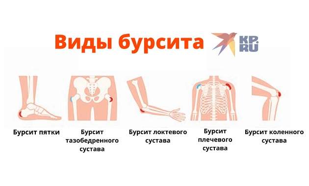 Виды бурсита