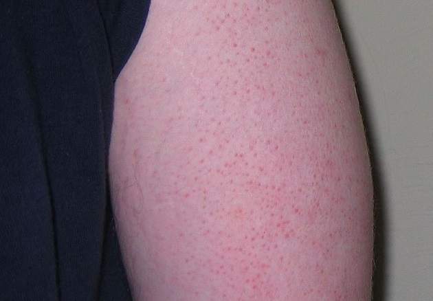 Симптомы фолликулярного кератоза у взрослых