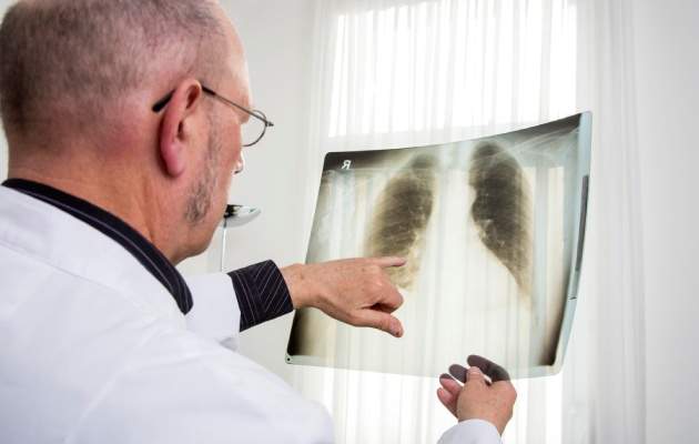 Рентген легкого