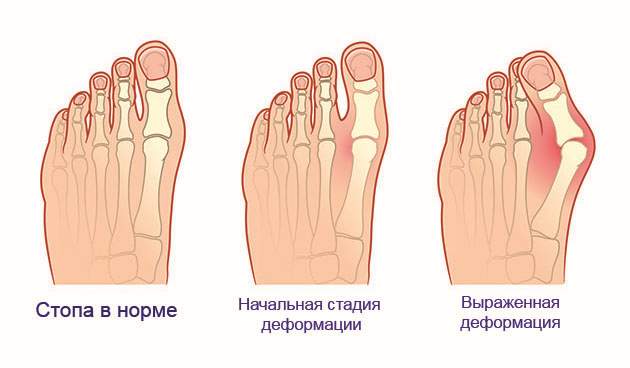 Стадии шишки на большом пальце ноги