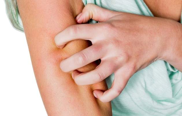 Стригущий лишай