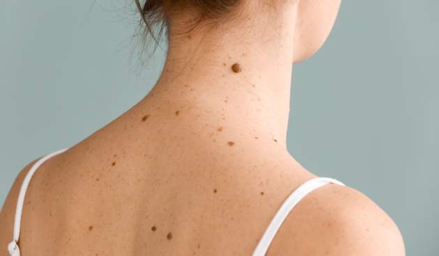 Эффективные способы борьбы с меланомой кожи