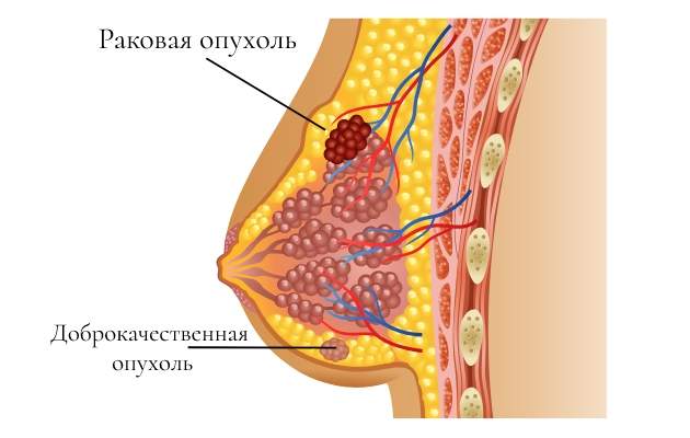 Оптимальные методики выявления рака молочной железы