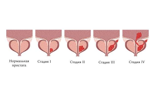 Рак простаты