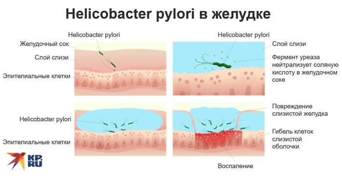 Helicobacter pylori в желудке
