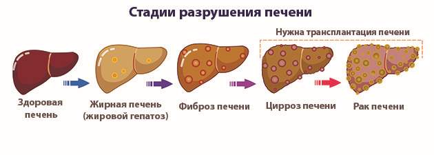 Эффективные способы терапии рака печени