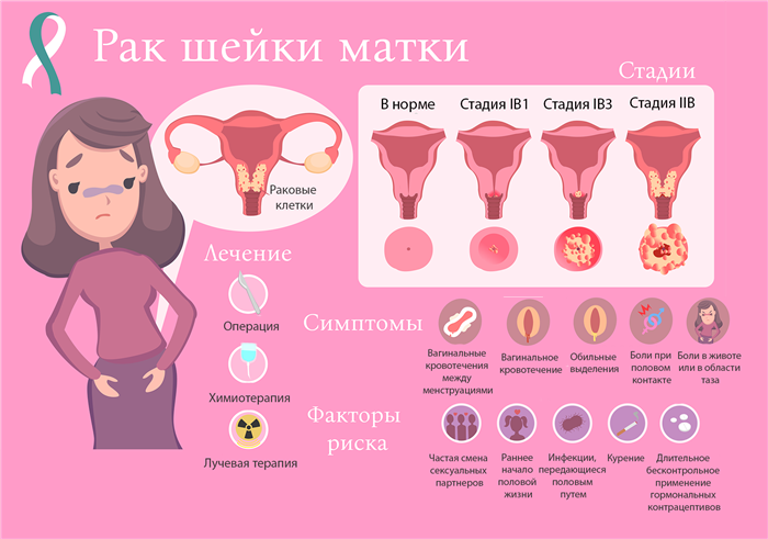 Стадии и симптомы РШМ по FIGO