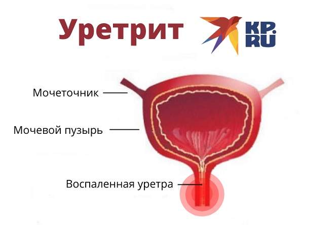 Уретрит у женщин