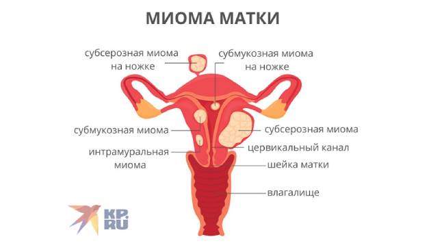 Миома матки