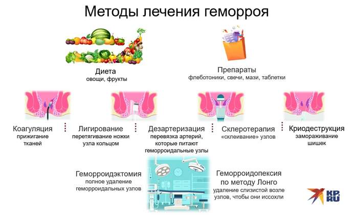 Методы лечения геморроя
