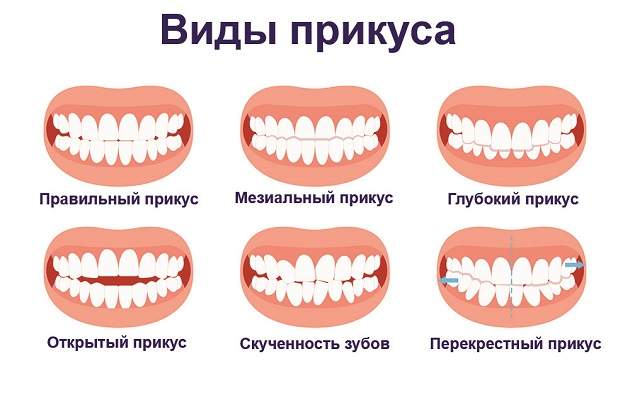 Виды прикуса