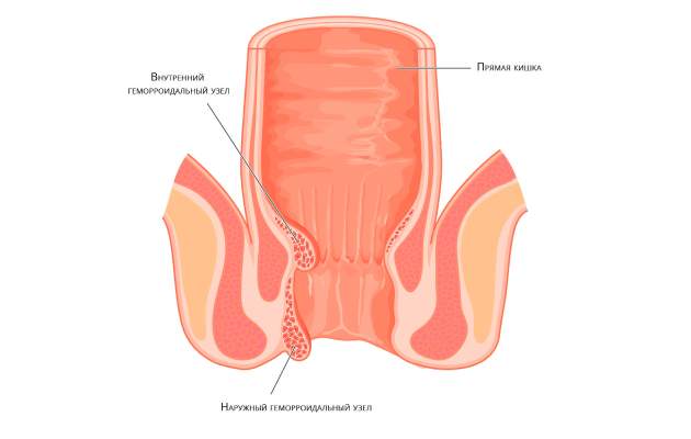 Что такое внутренний геморрой