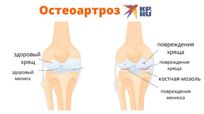 Остеоартроз