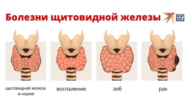 Болезни щитовидной железы