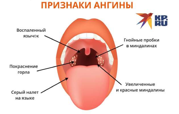Признаки ангины у взрослых