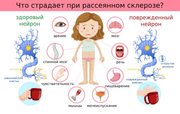 Симптомы рассеянного склероза