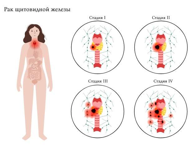 Рак щитовидной железы