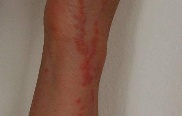 Укусы клопов