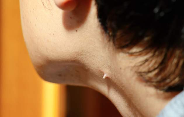 Вирус папилломы человека (ВПЧ)