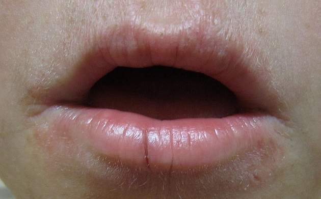 Симптомы хейлита у взрослых