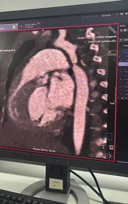 Шанс на жизнь: в Караганде впервые прооперировали младенца с коарктацией аорты (2)