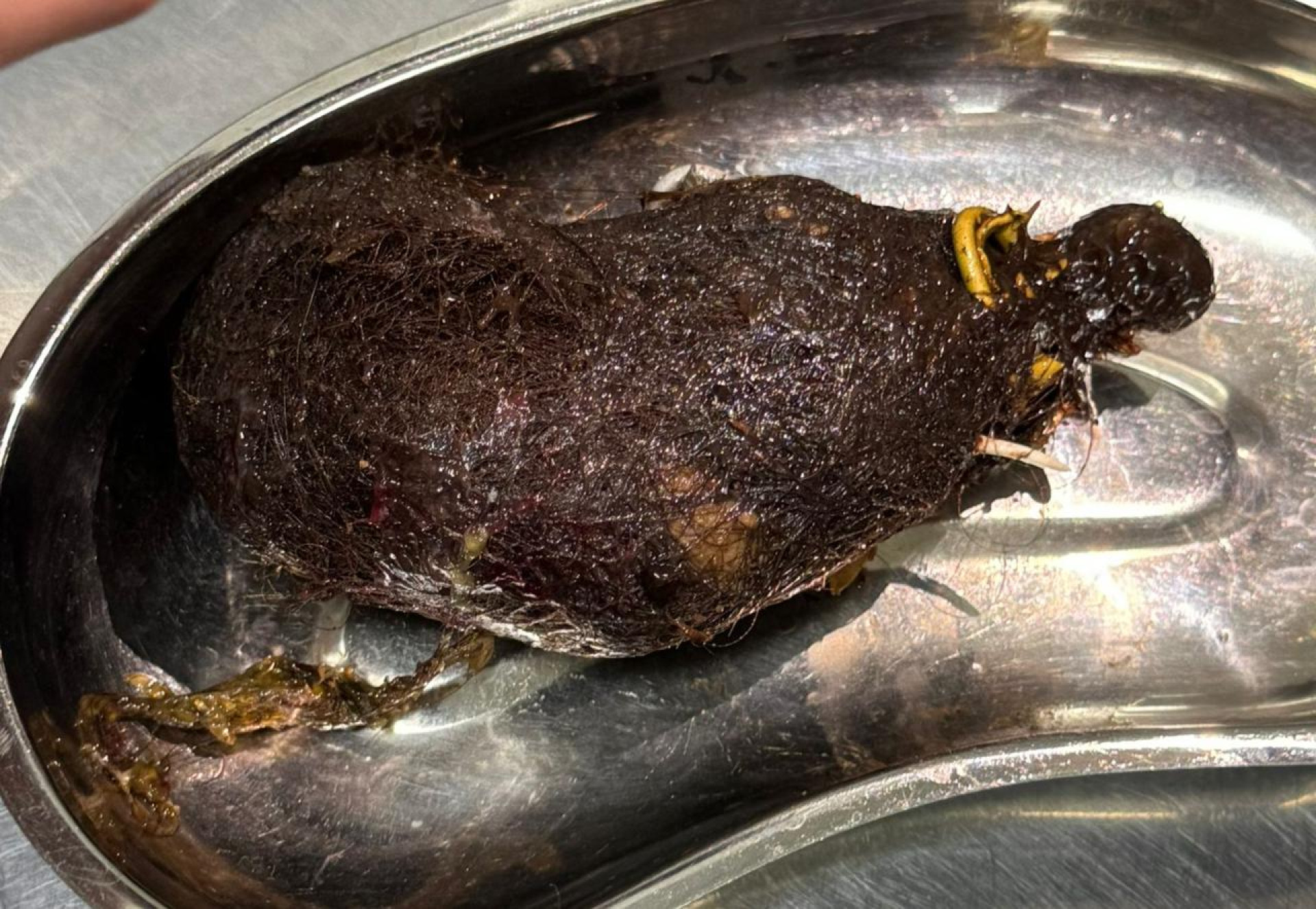 Операция на девочке с трихобезоаром